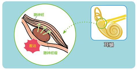 耳鳴是什麼感覺|耳鳴原因有3種，一直耳鳴怎麼辦？舒緩耳鳴症狀醫師。